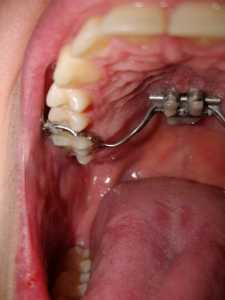 right molar
