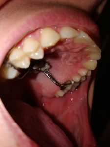 left molar