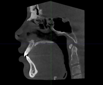 CBCT profil