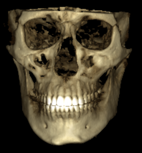 CBCT front