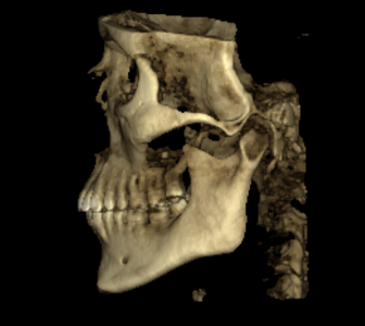 CBCT lijevi profil