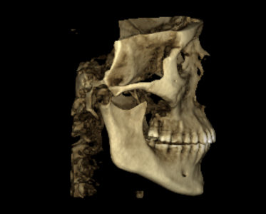 CBCT desni profil