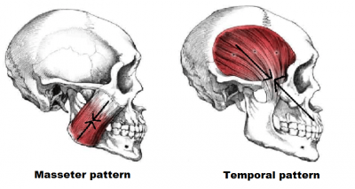 temporalmasseterpattern