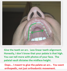 palate