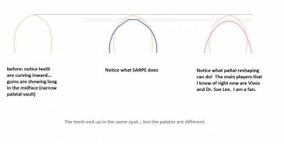 palatal reshaping