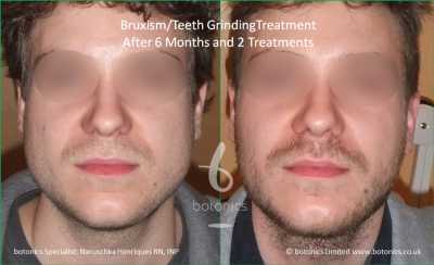 bruxism male botox teeth grinding jaw clenching masseter jaw reduction treatment before and after botonics naruschka henriques 1