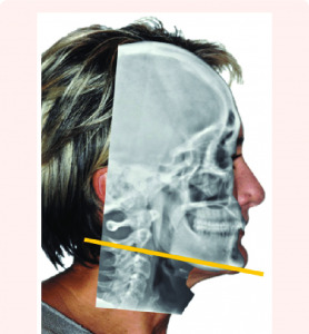 Superimposition profile view of the patients photo and the latero lateral X ray
