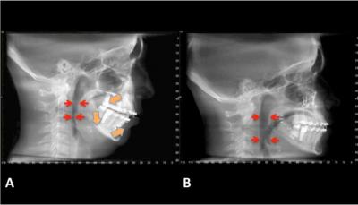 cephalometric x ray of airway obstruction
