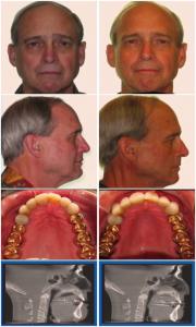 Tom Colquit DDS before and after homeoblock
