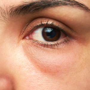 eye bags