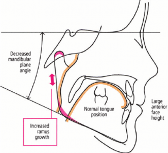Tracing of a child after adenotonsillectomy Because of normalization of breathing and