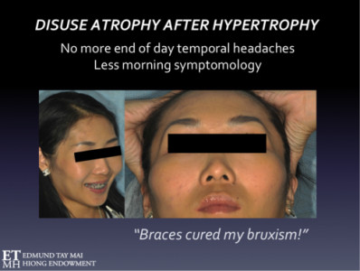 temporalisbruxism