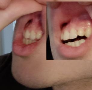 lowermaxillaforward