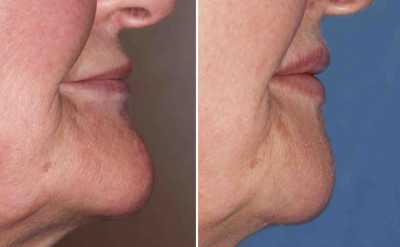 Older Chin Reduction result side view Dr Barry Eppley Indianapolis