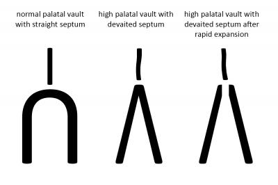 palatal vault