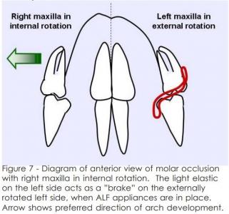 preventing asymmetric expansion