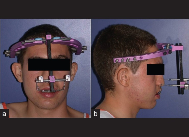 Rigid External Distraction System