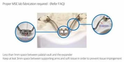 MSE fabrication
