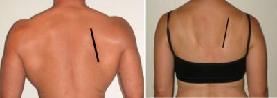 Osar stabilizing shoulder scapula upward rotation posterior tilt2 750x267 1
