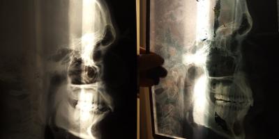 2 years mewing xrays