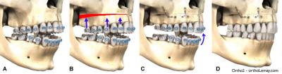 maxillary impaction maxillaire chirurgie orthodontie