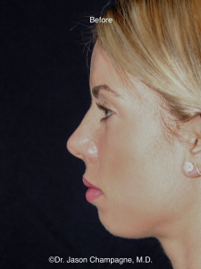 retruded chin 2