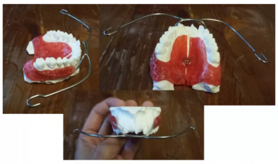facepulling headgear appliance