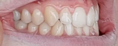 side teeth