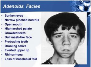adenoids facies 300x221