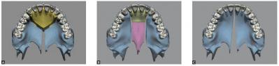 segmented lefort