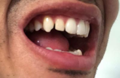 bort